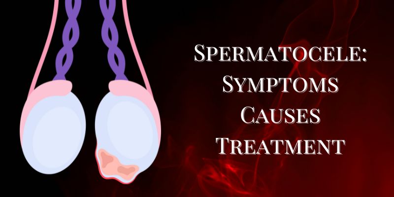 Spermatocelectomy spermatocelectomy
